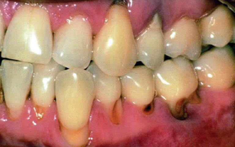 Cáries na Vida Adulta: Descubra Como Proteger Seus Dentes e Manter um Sorriso Saudável