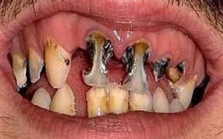 Cárie em Adultos Existe? Descubra o Que Pode Estar Destruindo Seus Dentes Mesmo Depois dos 40!