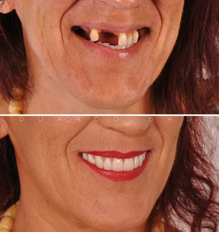 Quer Chegar aos 60 com Seus Próprios Dentes? Descubra Como Evitar a Perda Dentária na Maturidade!
