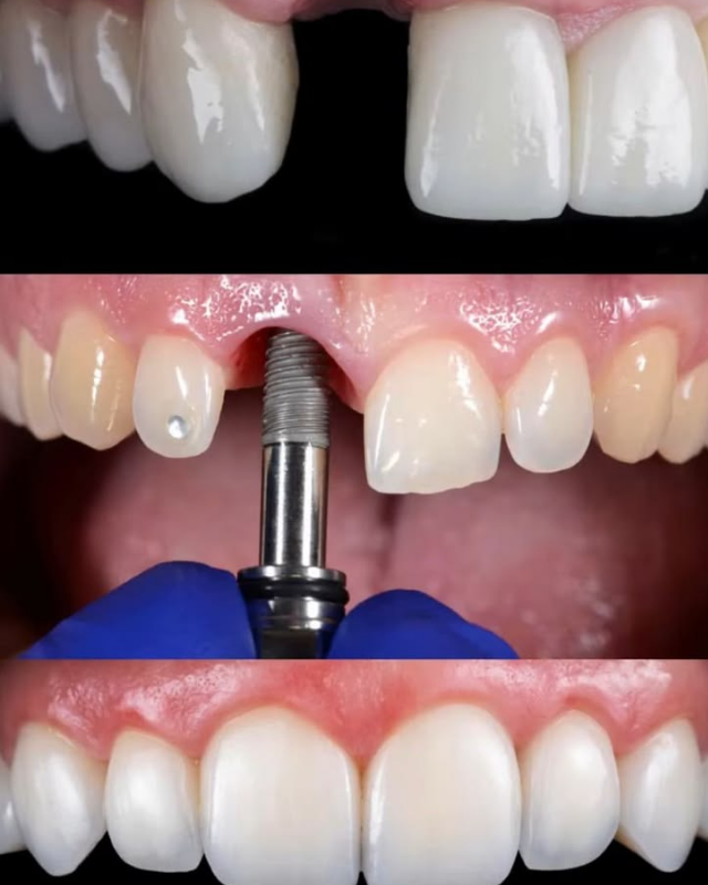 Fez um Implante Dentário? Descubra Como É a Recuperação e Quando Você Poderá Voltar a Mastigar Bem