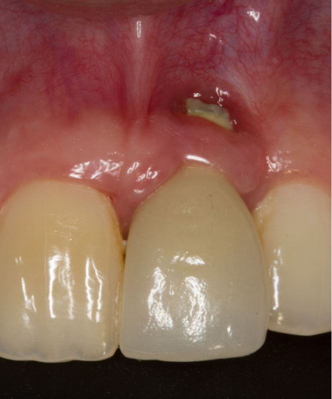 Vai Fazer um Implante Dentário? Descubra Quando o Enxerto Ósseo É Necessário e Como Ele Pode Ajudar