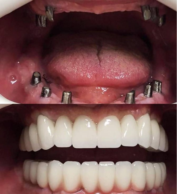 Quer Recuperar Seu Sorriso com Implantes? Descubra Quanto Custa o Tratamento e o Que Você Precisa Saber Antes de Começar