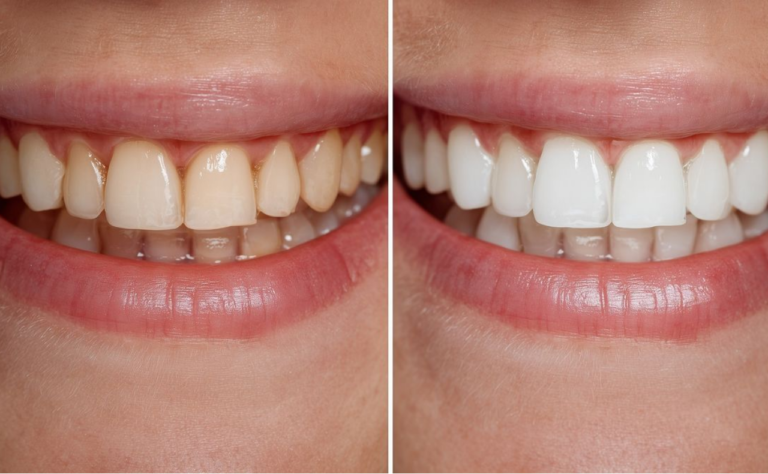 Clareamento Dental: Quer Manter os Dentes Brancos por Mais Tempo? Descubra Quanto Dura o Resultado!