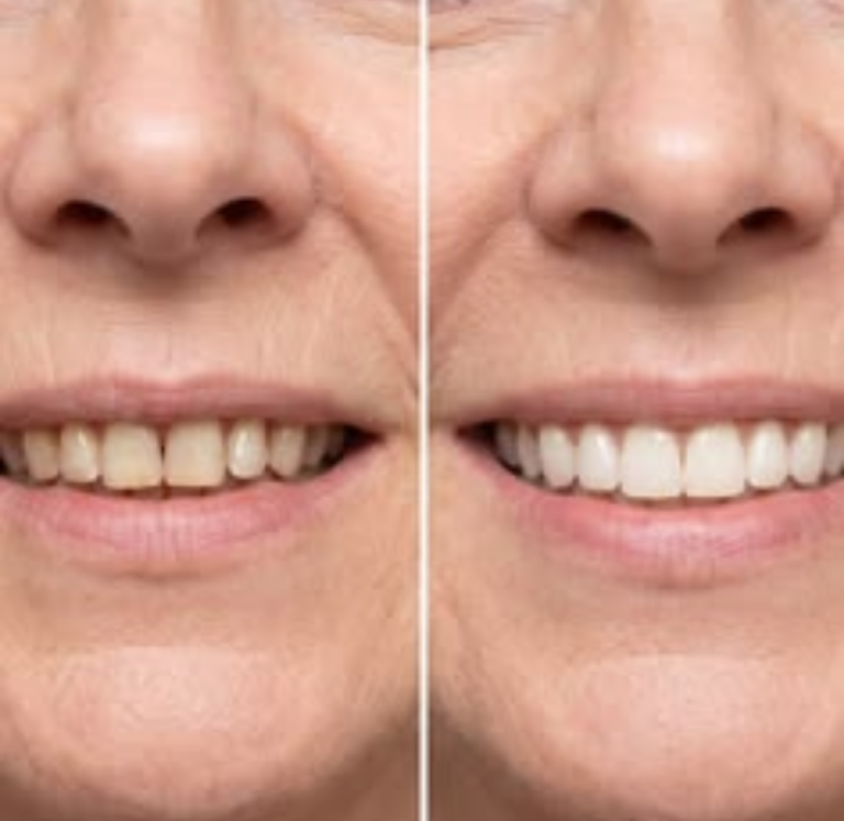 Quer Ter um Sorriso Mais Jovem Depois dos 40? Descubra Como Cuidar dos Dentes Naturalmente!