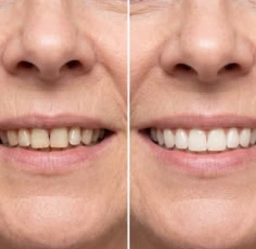Quer Ter um Sorriso Mais Jovem Depois dos 40? Descubra Como Cuidar dos Dentes Naturalmente!