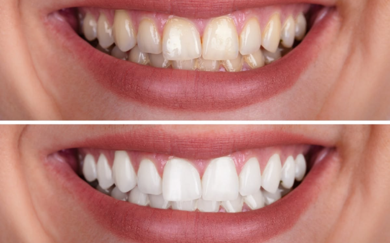 Quer Recuperar a Confiança no Seu Sorriso Depois dos 40 Anos? Descubra Como a Estética Dental Pode Ajudar!