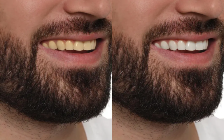 Fez Clareamento Dental Após os 40 Anos? Veja o Que Após os 40 anos Você Deve Evitar Para Manter os Dentes Brancos por Mais Tempo!