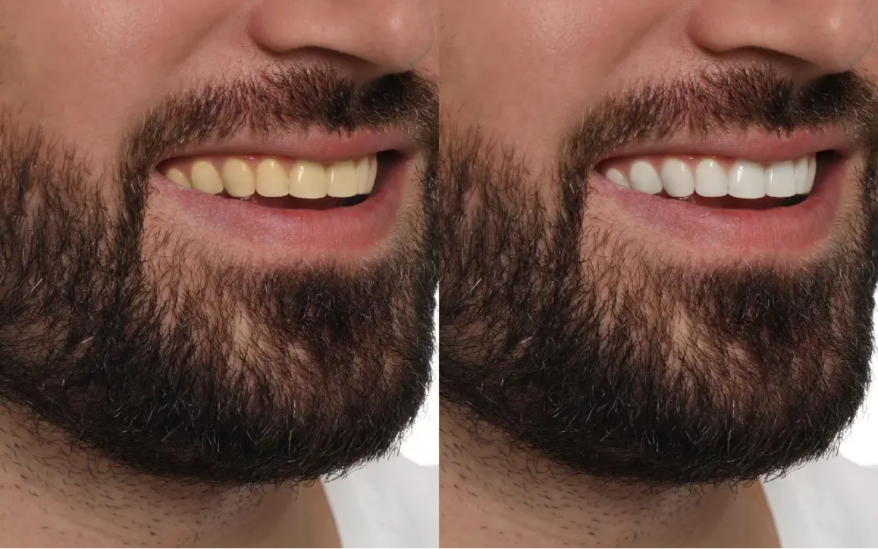 Fez Clareamento Dental Após os 40 Anos? Veja o Que Após os 40 anos Você Deve Evitar Para Manter os Dentes Brancos por Mais Tempo!