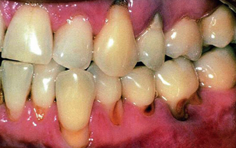 Cárie na Raiz do Dente: Você Tem Mais de 40 Anos? Descubra Como Proteger Seus Dentes Antes Que Seja Tarde!