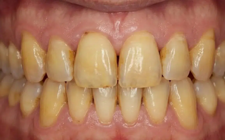 Quer Recuperar o Branco dos Seus Dentes Depois dos 40? Descubra Como Combater o Amarelamento e Conquistar um Sorriso Mais Bonito!