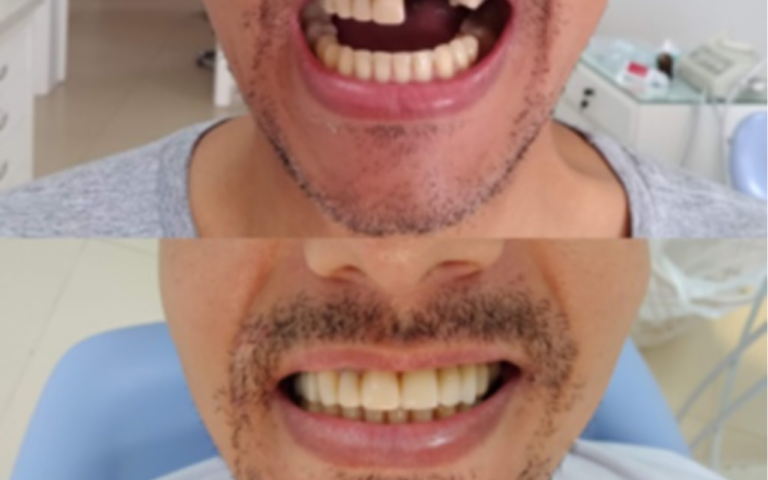 Implante Dentário Vale a Pena Depois dos 40?