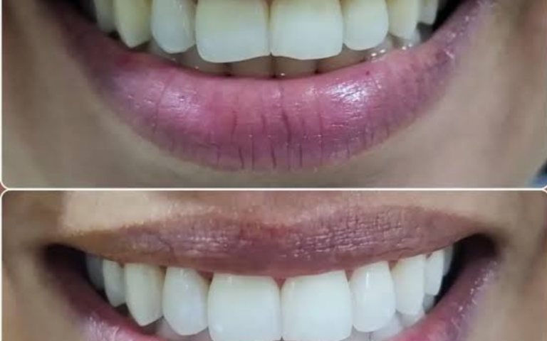 Clareamento Dental Depois dos 40 Funciona?