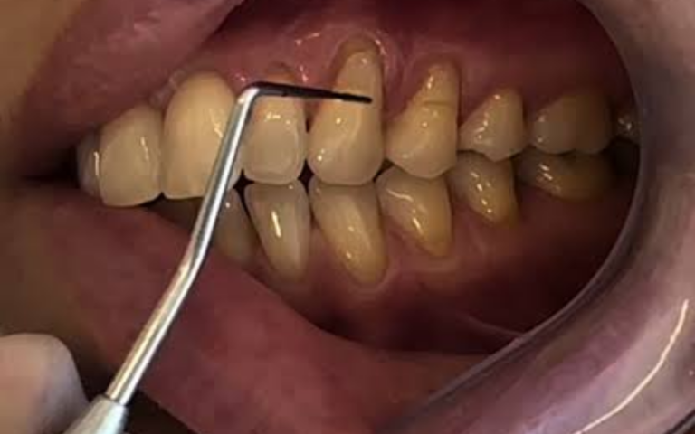 Sua Gengiva Está Encolhendo e Seus Dentes Parecem Mais Compridos? Descubra as Causas da Retração Gengival e Como Tratar!