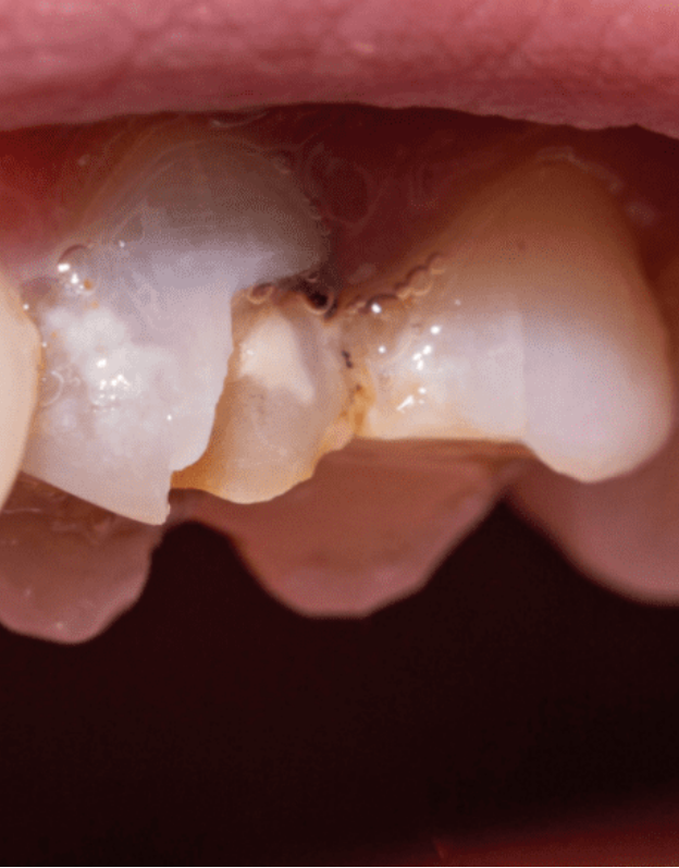 Seus Dentes Estão Ficando Mais Fracos Depois dos 40? Descubra o Que Fazer Para Fortalecer os Dentes e Proteger Seu Sorriso!