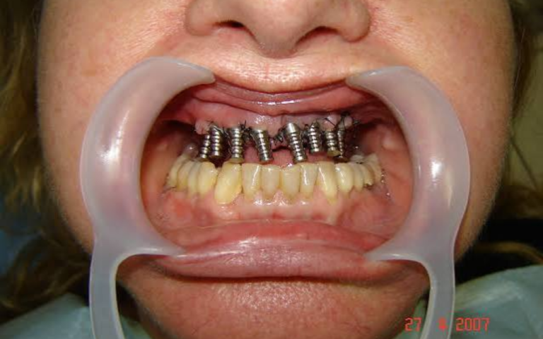 Está Pensando em Colocar um Implante Dentário? Descubra Como Funciona o Procedimento e Como Recuperar Seu Sorriso com Segurança!