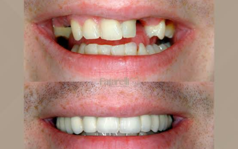 Está Faltando um ou Mais Dentes? Descubra as Opções de Próteses Dentárias Modernas Para Recuperar Seu Sorriso e Voltar a Mastigar com Confiança!