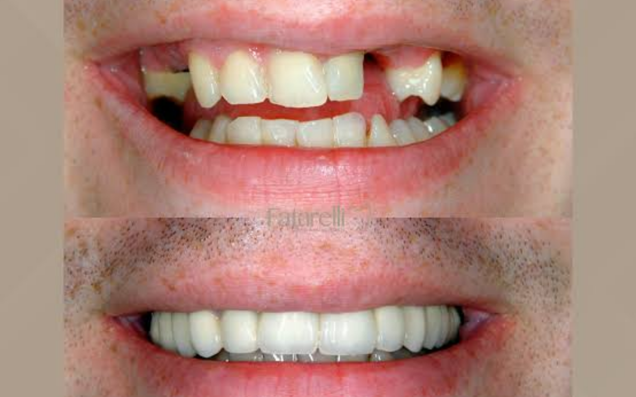 Está Faltando um ou Mais Dentes? Descubra as Opções de Próteses Dentárias Modernas Para Recuperar Seu Sorriso e Voltar a Mastigar com Confiança!