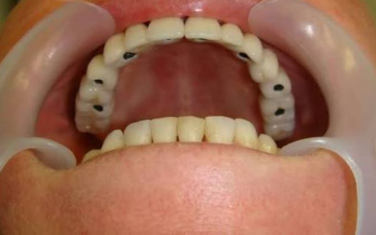 Está Pensando em Fazer um Implante Dentário? Descubra Quanto Tempo Ele Pode Durar e Como Cuidar Para Ter um Sorriso Bonito Por Muitos Anos!