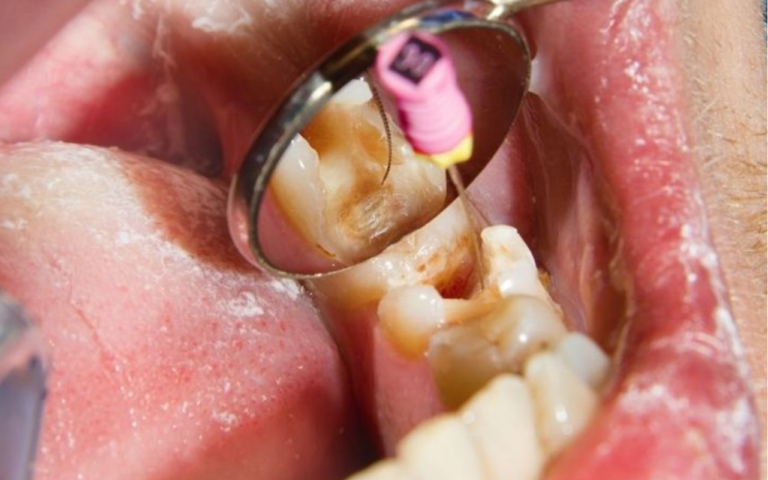 Está com Medo de Fazer um Canal Dentário? Descubra a Verdade Sobre a Dor e Conheça os Mitos Que Você Precisa Deixar Para Trás!