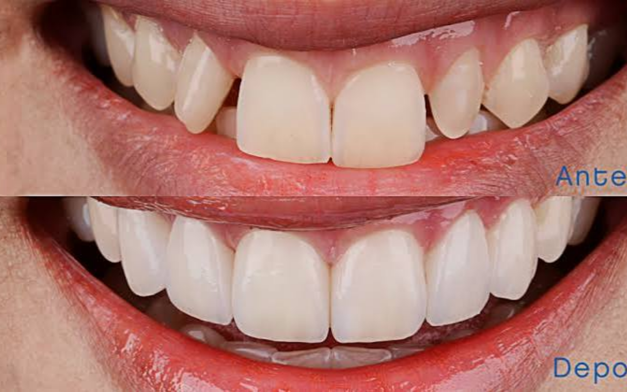 Quer Ter Dentes Bonitos Como os dos Artistas? Descubra as Vantagens das Facetas Dentárias e os Cuidados Para Manter um Sorriso Deslumbrante!