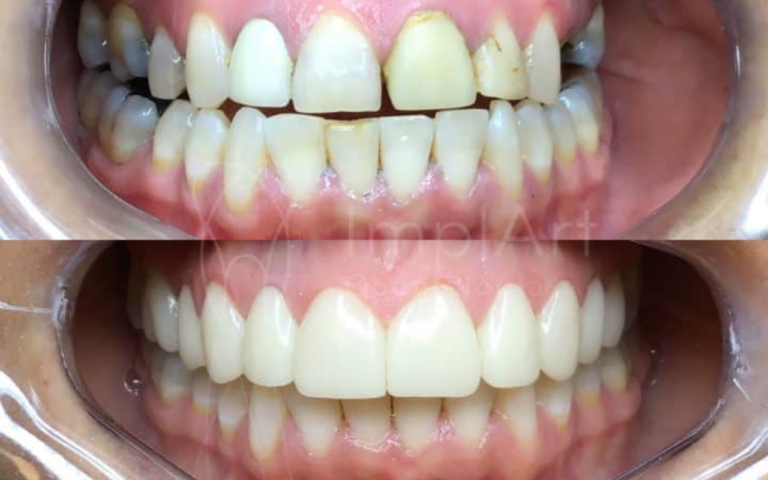 Quer Recuperar a Beleza do Seu Sorriso Depois dos 40? Descubra os Tratamentos Que Podem Transformar Seu Sorriso na Maturidade!