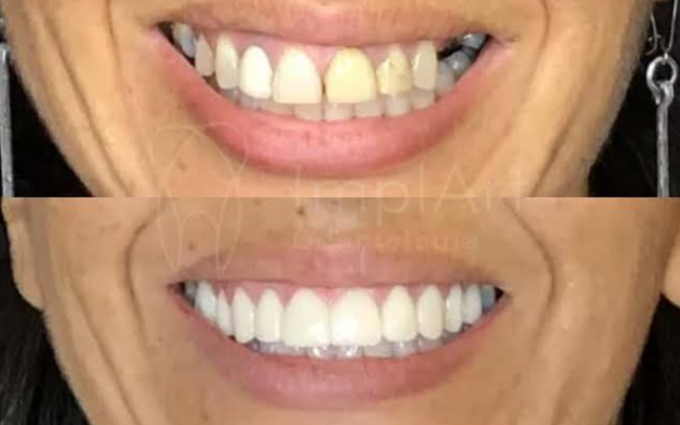 Os Melhores Tratamentos Estéticos Para os Dentes