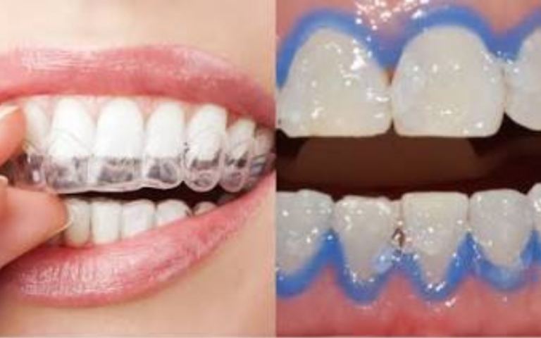 Quer Ter Dentes Mais Brancos e um Sorriso Deslumbrante? Descubra Se o Clareamento Caseiro ou Profissional é a Melhor Escolha Para Você!