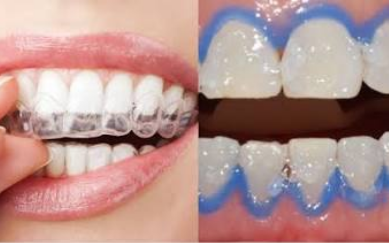 Quer Ter Dentes Mais Brancos e um Sorriso Deslumbrante? Descubra Se o Clareamento Caseiro ou Profissional é a Melhor Escolha Para Você!