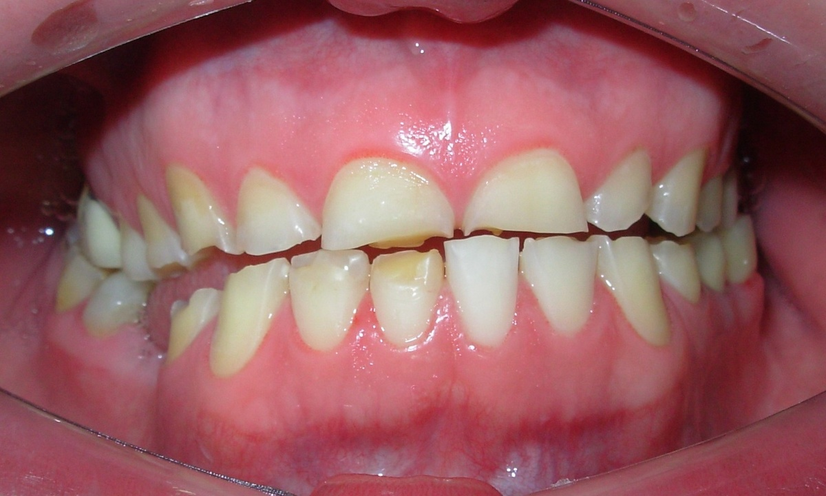 Você Dorme Mal e Não Sabe Por Quê? Descubra Como os Problemas Dentários Podem Estar Afetando Seu Sono!